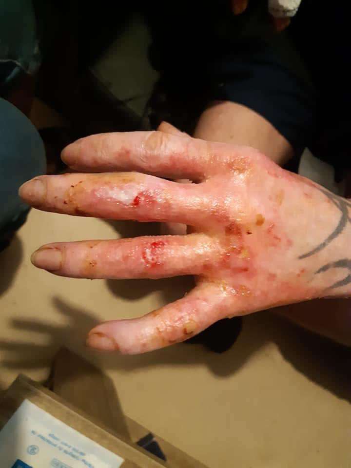 Serious injuries caused to a Belgian civilian who inadvertently touched an unexploded mustard gas projectile found in Belgium.
